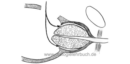 Abbildung Prinzip der transvesikalen Prostata-Adenomektomie nach Harris-Hryntschak zur Therapie der BPH