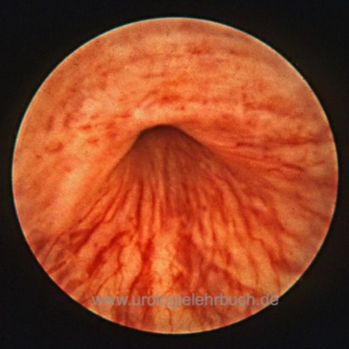Abbildung Normalbefunde der Zystoskopie: Männliche membranöse Harnröhre mit Sphinkter.