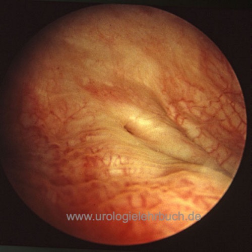 Abbildung Normalbefunde der Zystoskopie: Normales Ostium rechts.