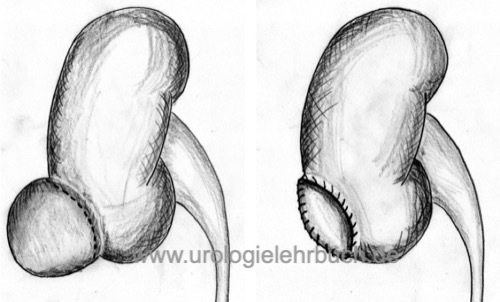 Abbildung Schematische Darstellung der Marsupialisation einer Nierenzyste.