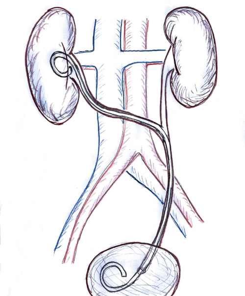 Abbildung Transureteroureterostomie Schema