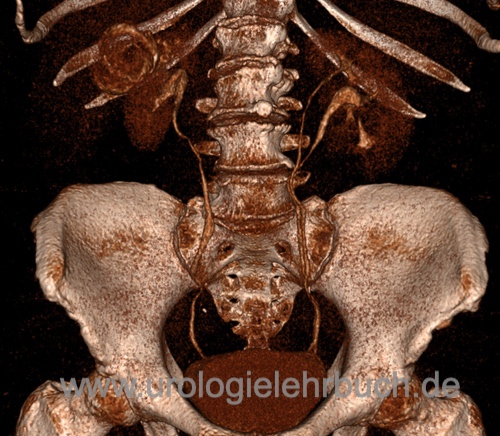 Abbildung Ureter duplex links in der CT