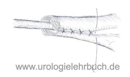 Abbildung Harnleiterpräparation vor Ureterzystoneostomie: Reduktion des Lumens durch Faltung der Ureterwand (Technik nach Starr)