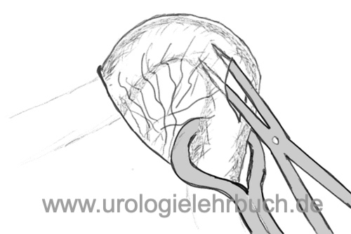 Abbildung Operative Technik der Vasektomie: Eröffnung der Faszienumhüllung des Samenleiters